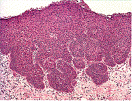 Squamous Cell Carcinoma