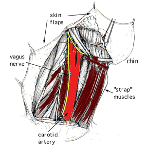 The image to the left shows the appearance of the neck after a radical neck dissection.